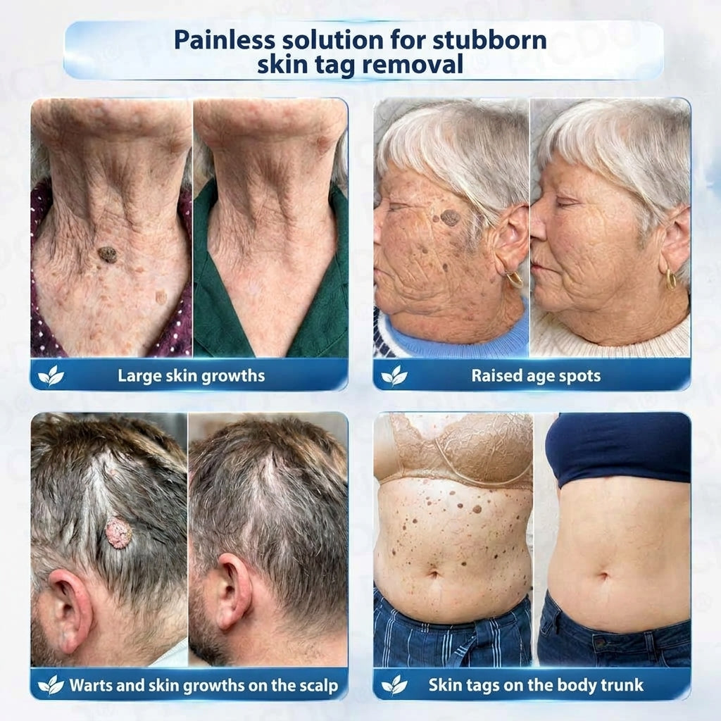 HISKIN® 10-in-1 Targeted Skin Tag & Dark Spot Cream – 7-Day Painless, Scar-Free Herbal Formula