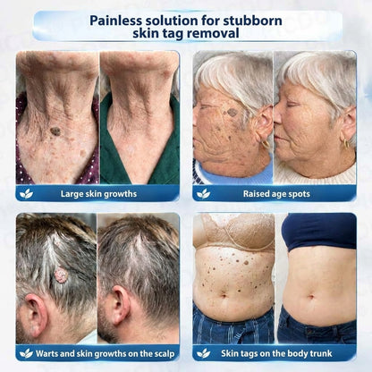 HISKIN® 10-in-1 Targeted Skin Tag & Dark Spot Cream – 7-Day Painless, Scar-Free Herbal Formula