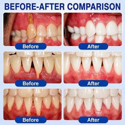 👨‍⚕️🦷 HISKIN® GumRevive – Intensive Targeted Gum & Receding Care Gel