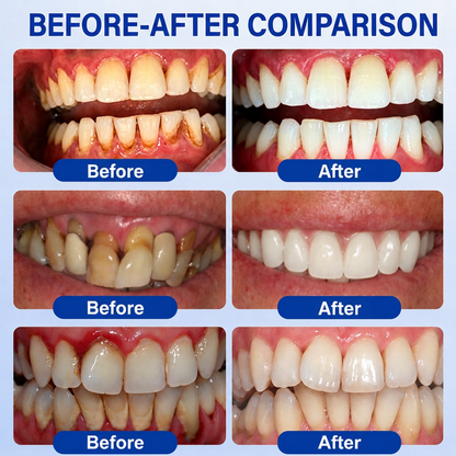 👨‍⚕️🦷 HISKIN® GumRevive – Intensive Targeted Gum & Receding Care Gel