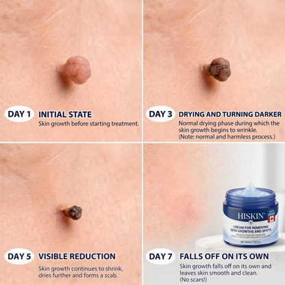 HISKIN® 10-in-1 Targeted Skin Tag & Dark Spot Cream – 7-Day Painless, Scar-Free Herbal Formula